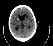 Brain MRI Picture